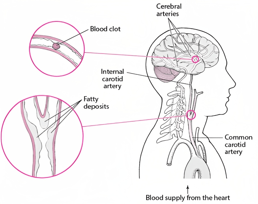 ඩිමෙන්ෂියාව