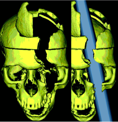 ෆීනියාස් ගේජ් Phineas Gage - ස්නායු විද්‍යා වංශ කතාවේ නොමැකෙන රෝගියා